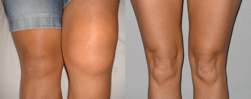 Kanepiõli kapslite kasutamise kogemus enne ja pärast Eva kasutamist